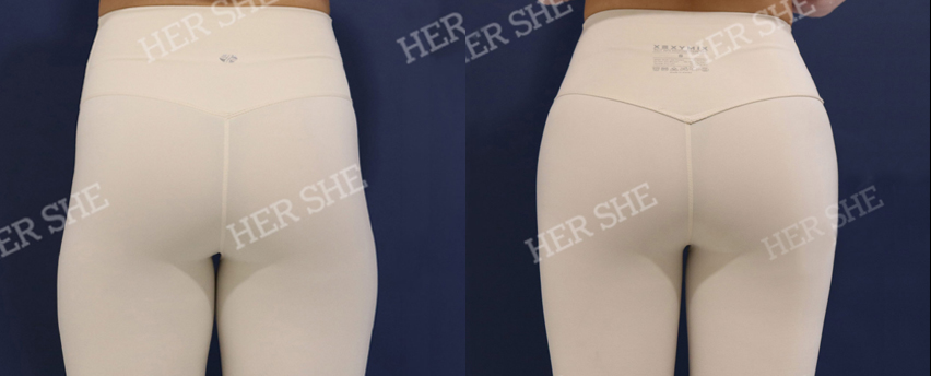 BEFORE & AFTER