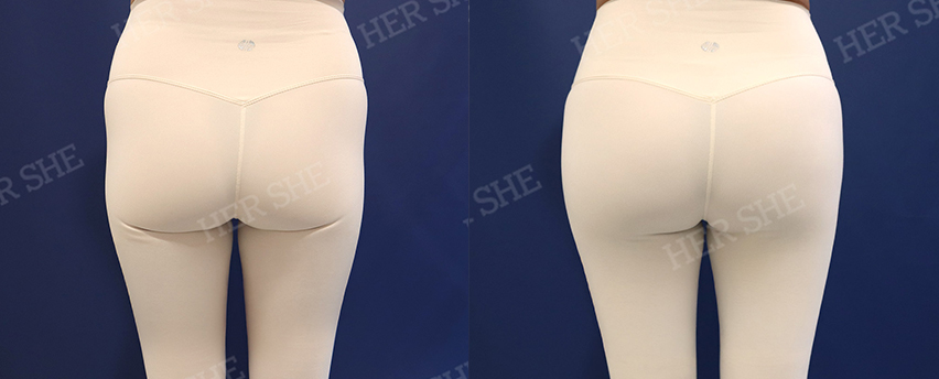 BEFORE & AFTER