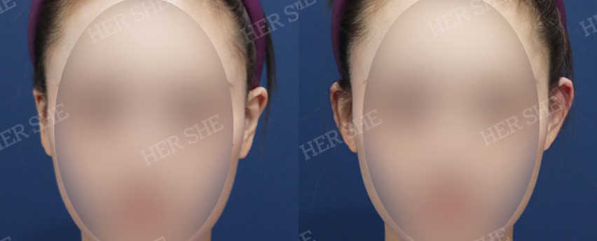 BEFORE & AFTER