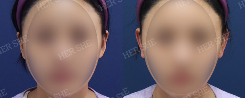 BEFORE & AFTER
